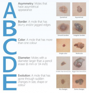 ABCDE Skin Cancer Check